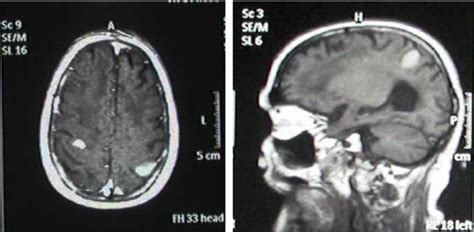 Brain MRI with and without contrast agent on third day | Download ...