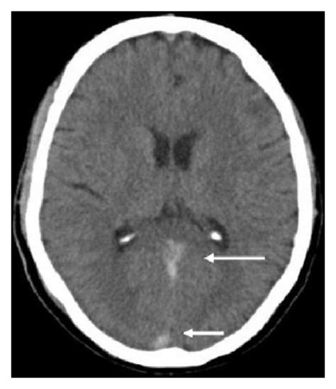 First CT scan brain without contrast showing suspicion of subarachnoid ...