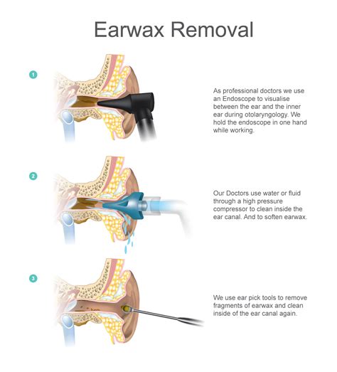 Ear Wax Removal London | Ear Microsuction | London Hearing