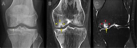 Cyst formation in the subchondral bone following cartilage repair - Gao ...