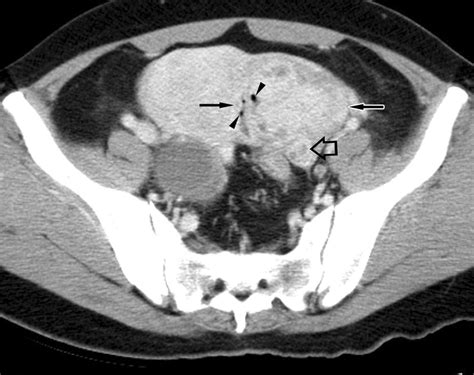 Tubo Ovarian Abscess Histology