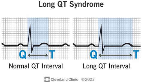 Congenital Long QT Syndrome ScienceDirect, 50% OFF