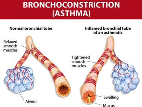 Asthma: Symptoms, Complications, and Treatment