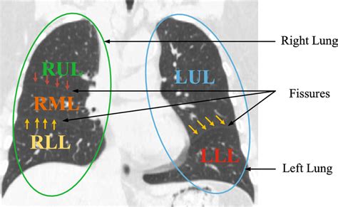 A coronal lung CT slice with visible fissures. Major fissures are ...