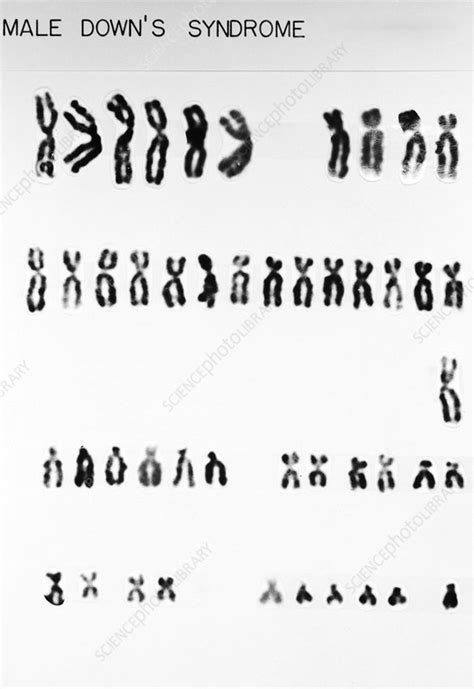 Down's Syndrome karyotype - Stock Image - C002/9918 - Science Photo Library