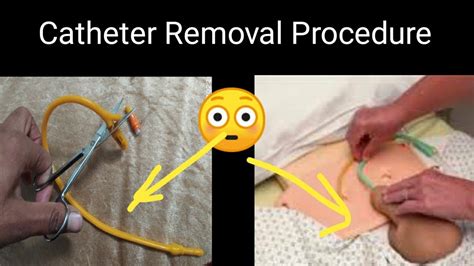 How To Remove Catheter With Scissors || Catheter Removal Procedure ...