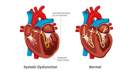 What ar Systolic Heart Failure Symptoms and Treatment | Dr. Raghu