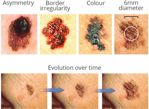 Cancer Lesions On Skin