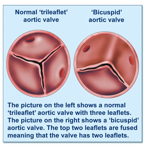 Bicuspid aortic valve - British Heart Valve Society