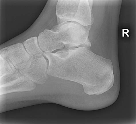 Stress Fracture Calcaneus X Ray | Hot Sex Picture