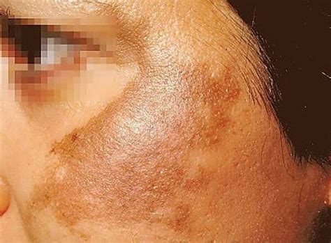 Melasma (Chloasma) - Pictures, Causes, Symptoms and Treatment