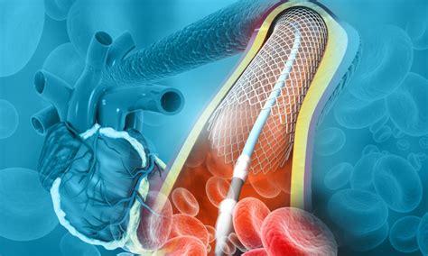 What is an Angioplasty, Types and Stents - Pulse Cardiology