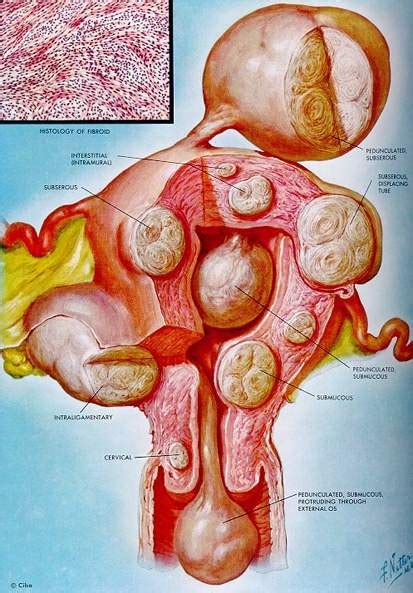 Myomectomy – VBGYN.com