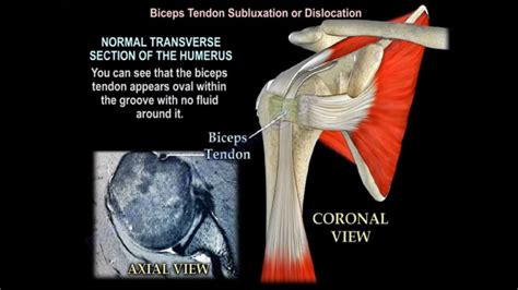 Biceps Tendon Dislocation