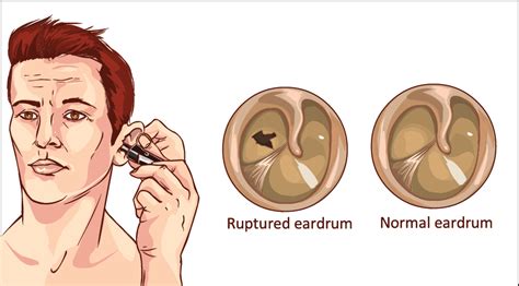 Symptoms of Ruptured Ear Drum | ENT Specialist Coimbatore