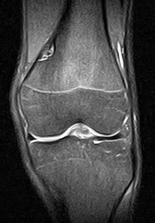 Fibrous Cortical Defect Mri