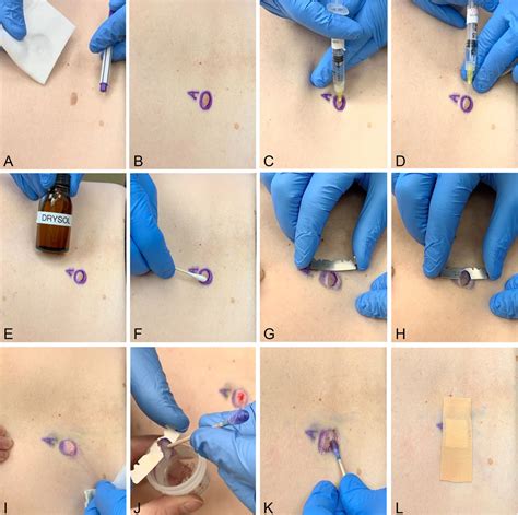 Shave biopsy technique and hemostasis pearl : Journal of the American ...