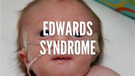 Edwards Syndrome Adults