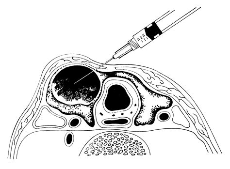 Pathology Outlines - FNA-general