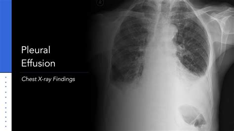 Chest X Ray Pleural Effusion