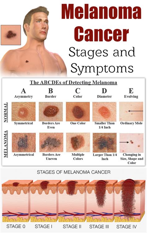 Malignant Melanoma Symptoms And Signs: Understanding the Warning ...