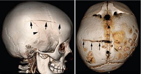 Skull fracture - pastorconnection