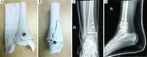 Figure shows the pre-surgical simulation of fracture fixation of a ...