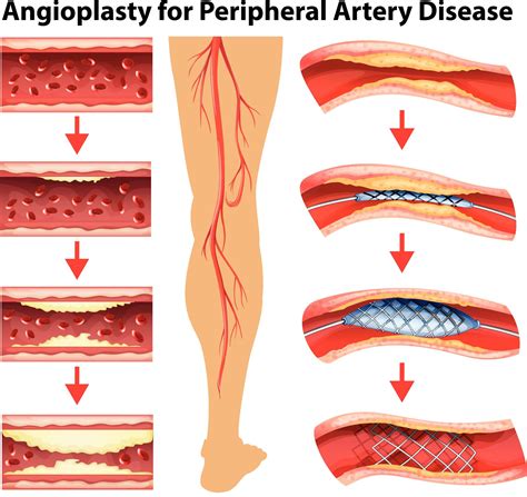 PTA Stent and Atherectomy in Lafayette LA - Restore Blood Flow and ...