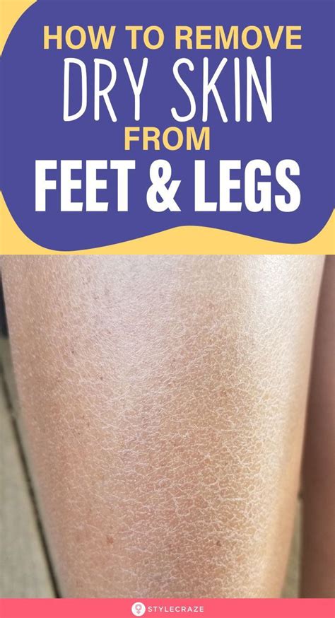 How To Remove Dry Skin From Your Feet And Legs in 2020 | Natural skin ...