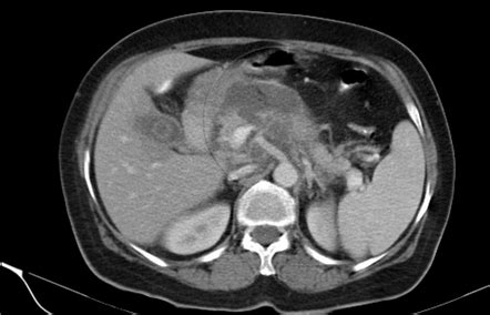 Necrotizing pancreatitis | Radiology Reference Article | Radiopaedia.org