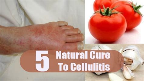 5 Home Remedies for Cellulitis | By Top 5. - YouTube