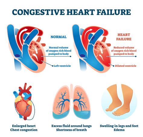 Chronic Systolic Heart Failure: An Ailment of All Times