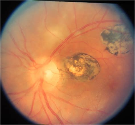 Uveitis, Uveitis Eye - Causes, Types, Symptoms, Diagnosis, Treatment