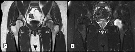 Bone marrow edema; A T1 coronal plane MRI plane with bone marrow edema ...