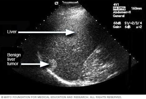 Liver problems - Diagnosis and treatment - Mayo Clinic