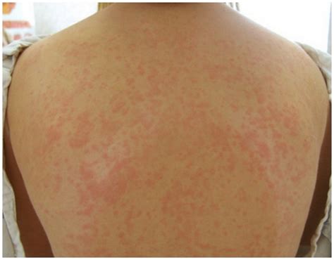 Maculopapular Rash – Causes, Symptoms, Pictures, Treatment