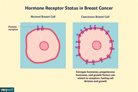 Hormone Receptor Status and Diagnosis in Breast Cancer