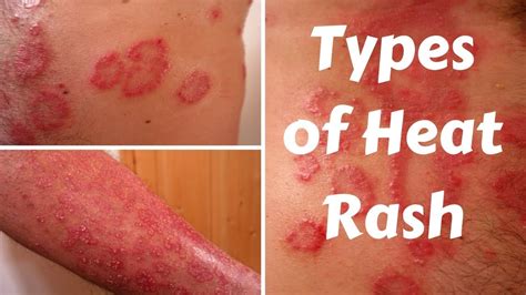 Heat Rash On Body / How To Heal Heat Rash Fast - 100% Guarantee ...