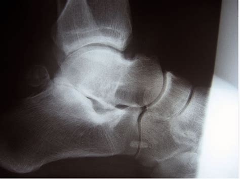 Subtalar Osteoarthritis - Sports Medicine Review