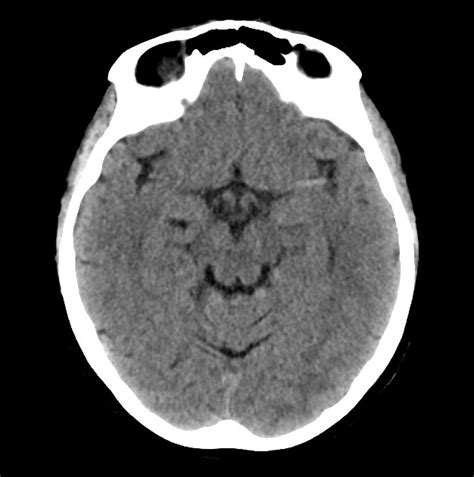 Mechanical thrombectomy