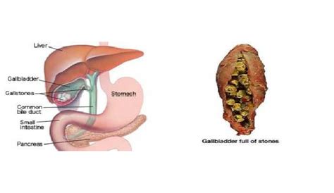 Gallbladder Stone Treatment in Ambedkar Nagar, Gallstone Surgery in Ambedkar Nagar