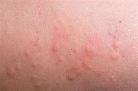 What are the Common Causes of Hives During Pregnancy?