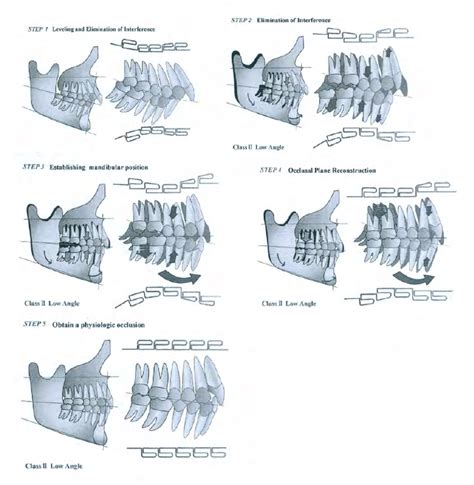 Sequence of class II deep bite treatment (Sato 2008) Step four/five ...