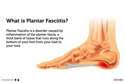 Plantar Fasciitis Causes And Treatment Top Sellers | bellvalefarms.com