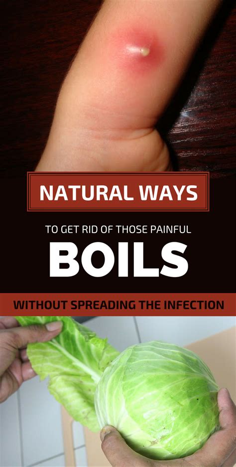 Natural Ways To Get Rid Of Those Painful Boils Without Spreading The ...