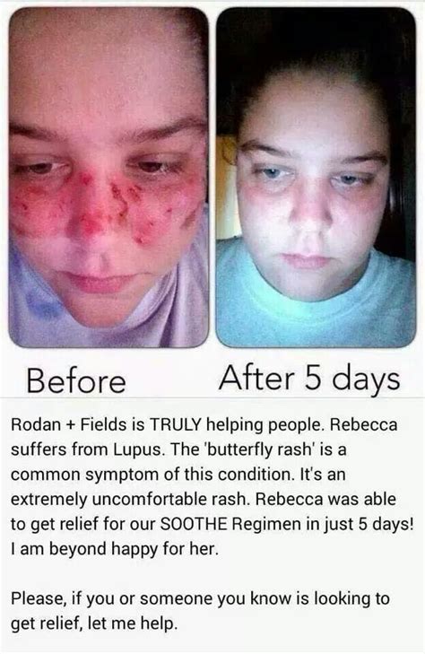 Butterfly rash from Lupus before and after Soothe Regimen safe for kids ...