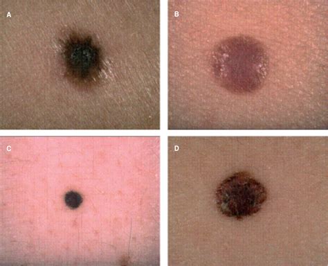 Melanoma - Malignant Melanoma (nodular Type) On Hand Photograph by ...