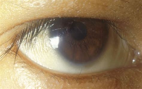 Community Eye Health Journal » The eye signs of vitamin A deficiency