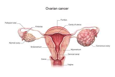 Ovarian Cancer Signs, Symptoms, and Diagnosis | Saint John’s Cancer ...