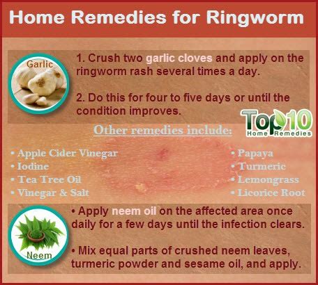 Home Remedies for Ringworm - Page 2 of 3 | Top 10 Home Remedies